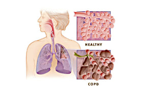 COPD and Whole Body Vibration Benefits