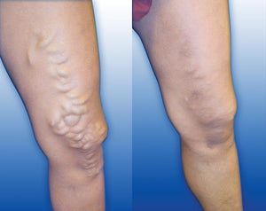 Preventing Varicose Veins with Whole Body Vibration Machines
